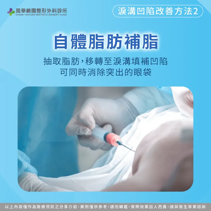 自體脂肪補脂-淚溝凹陷怎麼辦