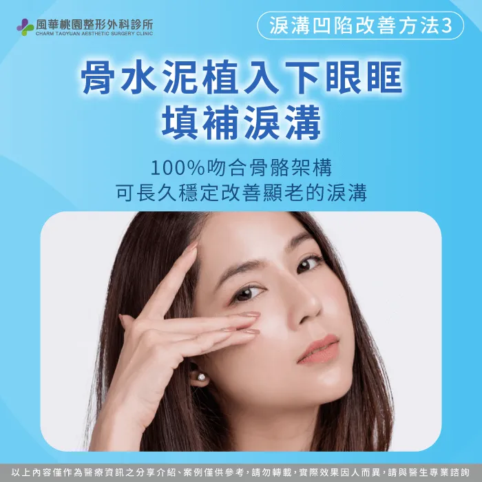 骨水泥植入下眼眶-桃園骨水泥整形推薦