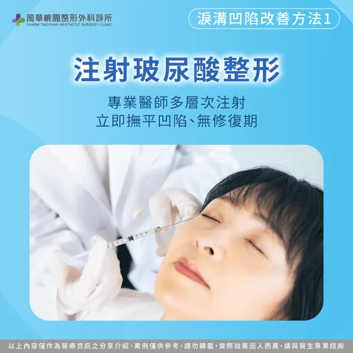 注射玻尿酸整形-淚溝整形