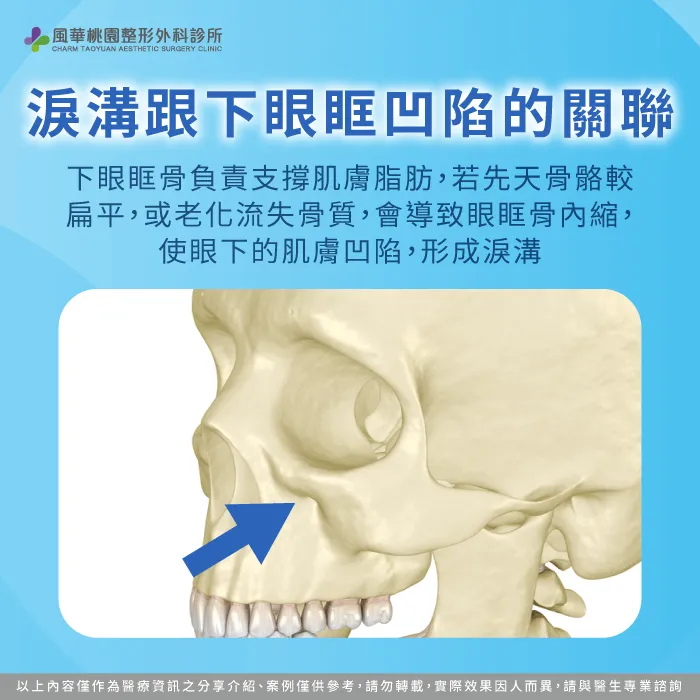 淚溝跟下眼眶凹陷的關聯-淚溝凹陷怎麼辦