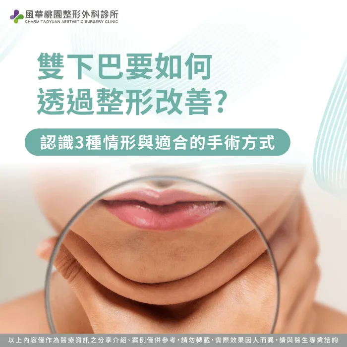 不同類型的雙下巴都有對應手術方式,可同時兼顧美觀與功能 雙下巴整形-雙下巴手術