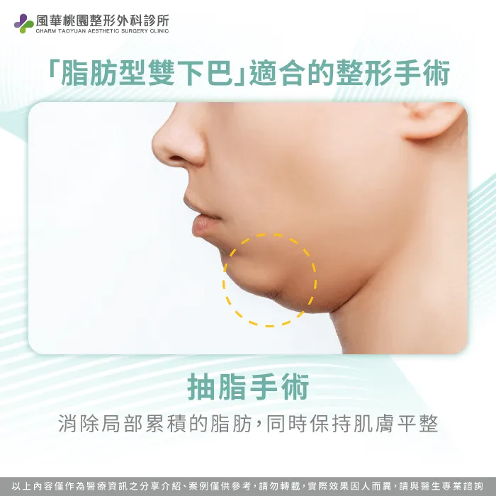 脂肪型雙下巴適合透過精雕抽脂手術消除局部累積脂肪,改善下巴線條,同時保持肌膚平整自然 脂肪型雙下巴-雙下巴手術