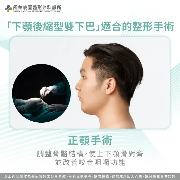 下顎後縮型雙下巴適合進行正顎手術,調整骨骼結構,使上下顎對齊 下巴後縮型雙下巴-雙下巴整形