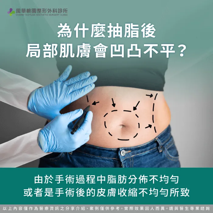 為什麼抽脂後會凹凸不平-抽脂後凹凸不平