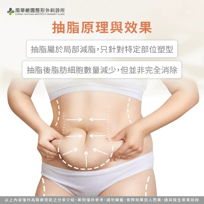 抽脂原理與效果-抽脂會復胖嗎
