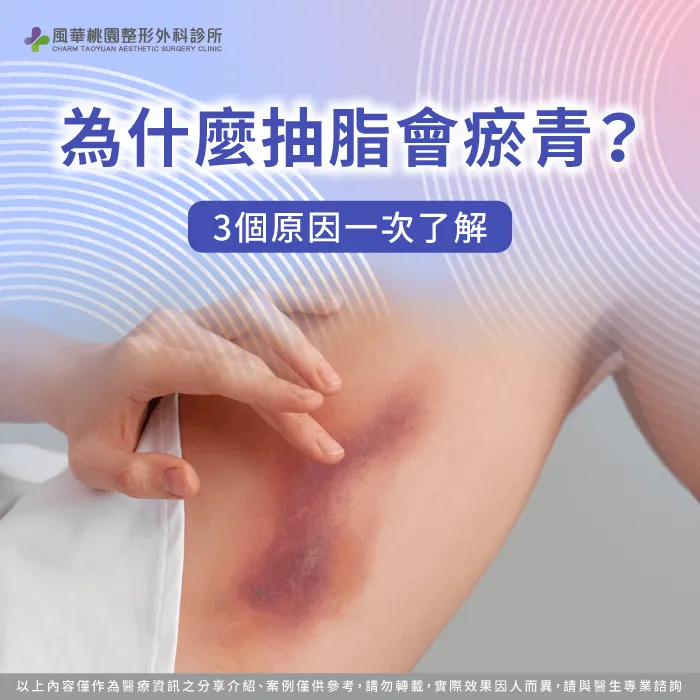 為什麼抽脂會瘀青-抽脂手術 瘀青
