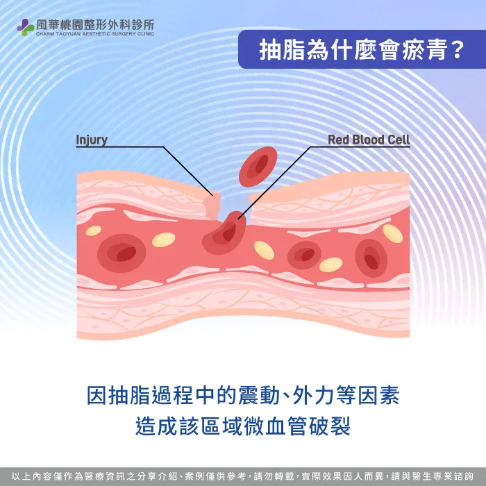 抽脂區域微血管破裂-為什麼抽脂會瘀青