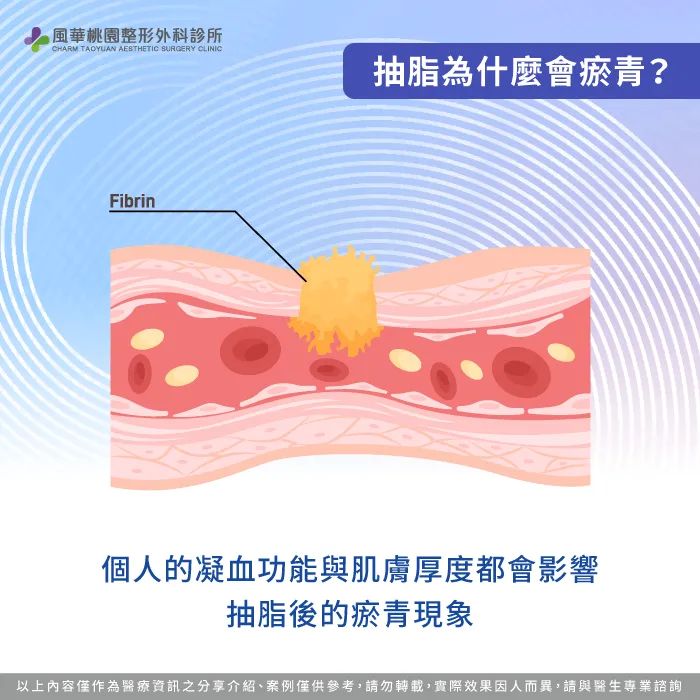 凝血功能與肌膚差異-為什麼抽脂會瘀青