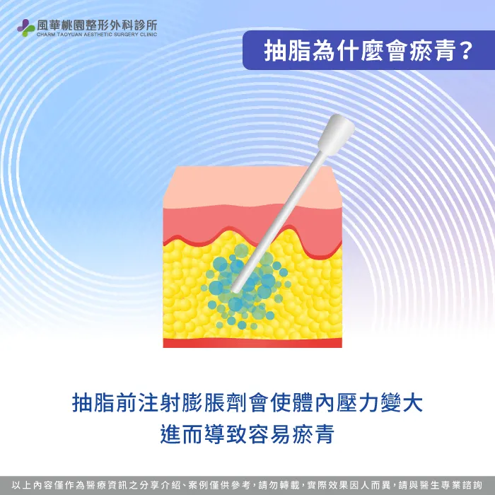 膨脹液使組織壓力變大-為什麼抽脂會瘀青