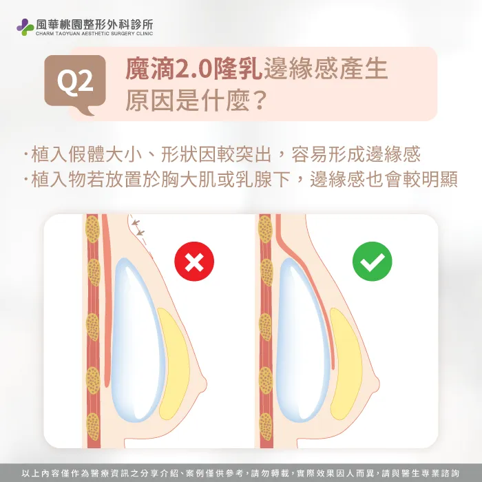 隆乳後邊緣感產生原因-魔滴2.0隆乳後邊緣感