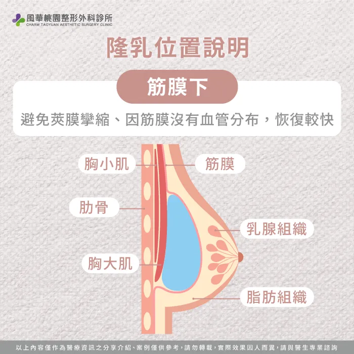 筋膜下-魔滴2.0隆乳放的位置