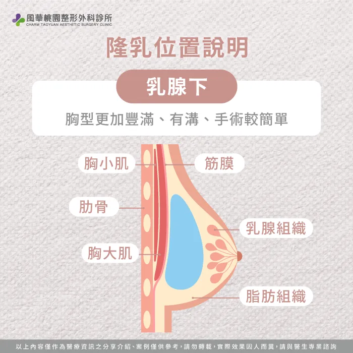 乳腺下-魔滴2.0隆乳放的位置