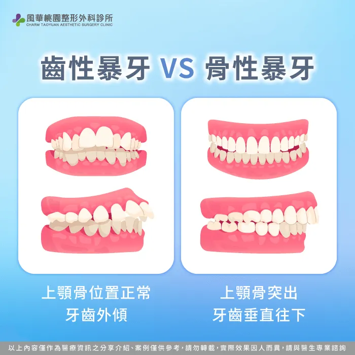了解齒性暴牙與骨性暴牙-骨性暴牙正顎手術