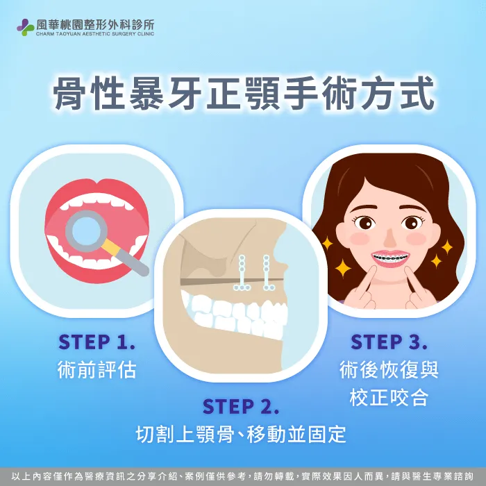手術方式-骨性暴牙正顎手術