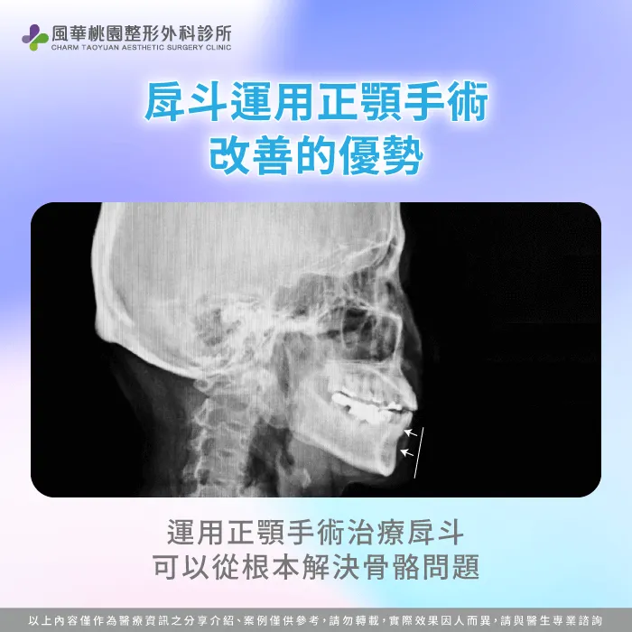正顎手術對戽斗的好處-戽斗一定要正顎嗎