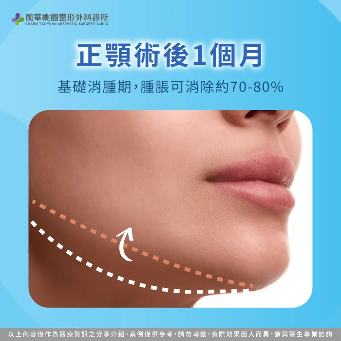 正顎術後一個月是基礎消腫期 術後1個月-正顎手術消腫時間