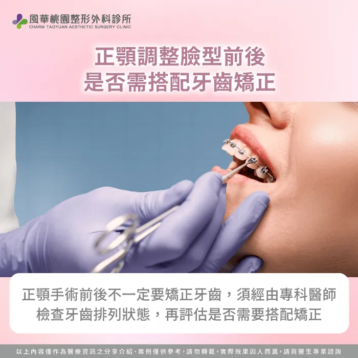 正顎要搭配牙齒矯正嗎-臉型不對稱正顎