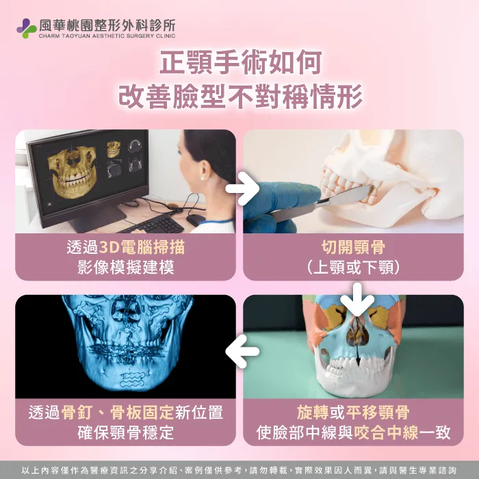 正顎手術如何改善臉型不對稱-臉型不對稱正顎