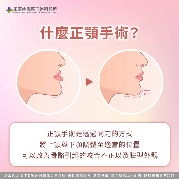 什麼是正顎-正顎一定要矯正嗎