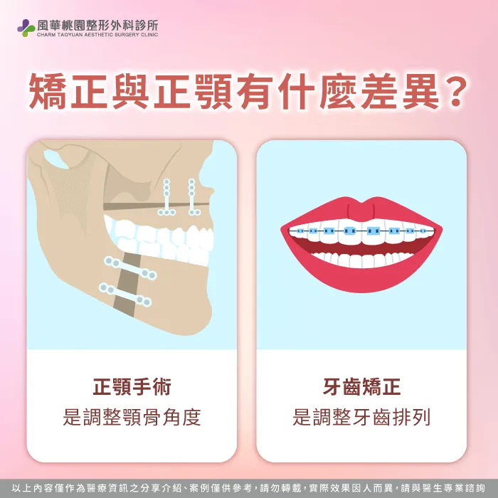 矯正與正顎的差異-正顎一定要矯正嗎