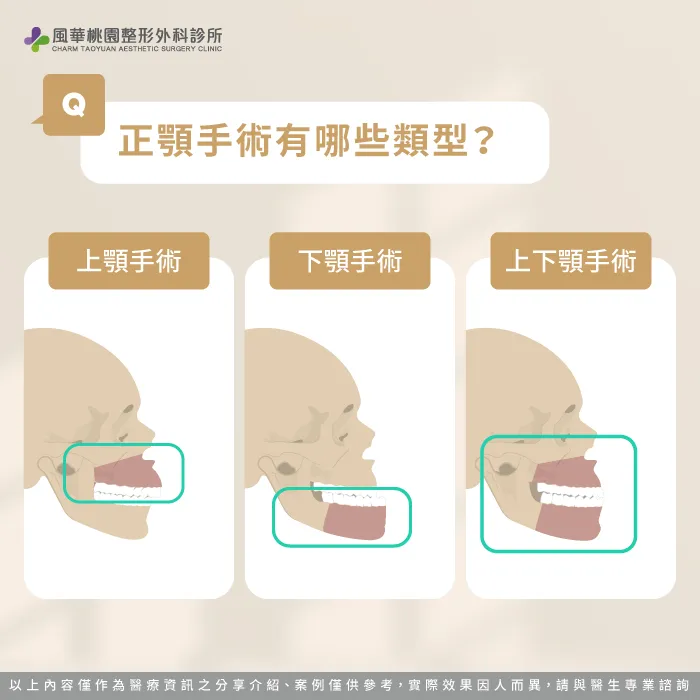 正顎手術類型-正顎是什麼
