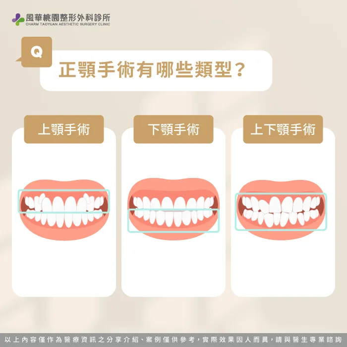 正顎手術類型-正顎是什麼