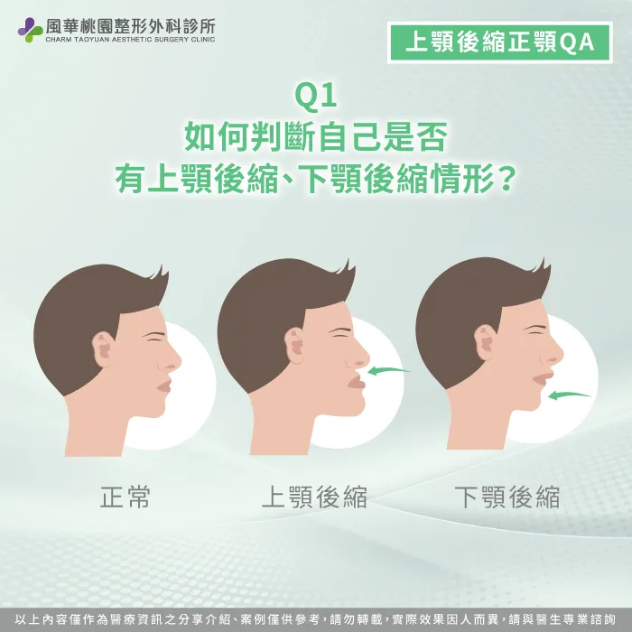 如何判斷自己是否有上顎後縮-上顎後縮正顎