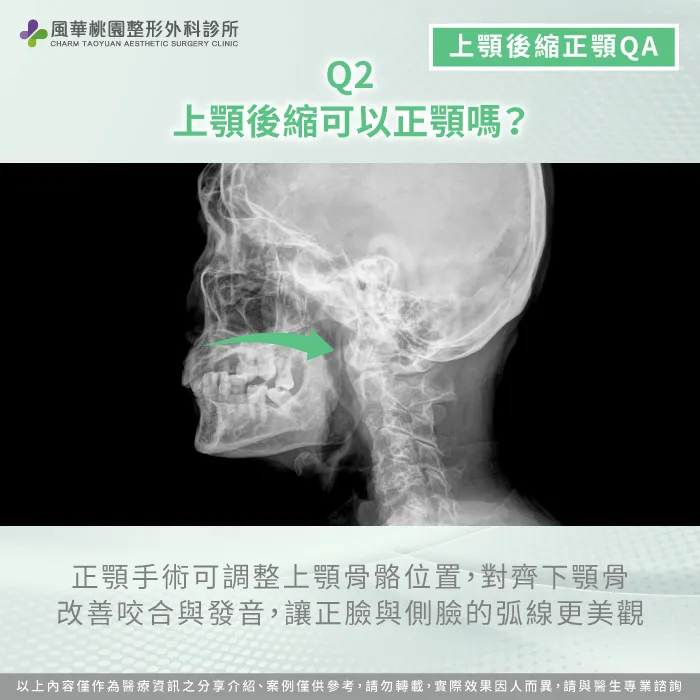 上顎後縮可以正顎嗎-上顎內縮正顎