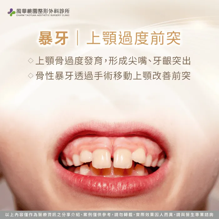 暴牙-正顎手術必要嗎