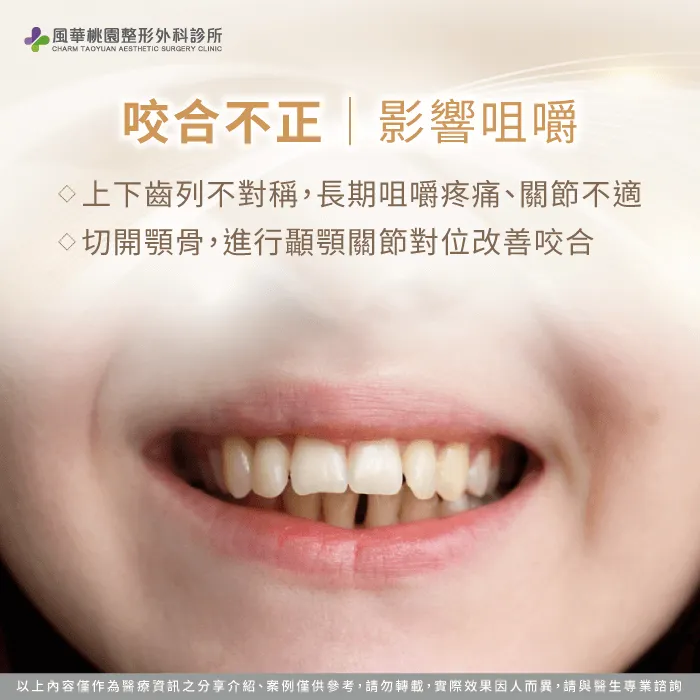 咬合不正-正顎手術必要嗎