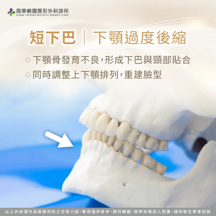 短下巴-正顎手術必要嗎
