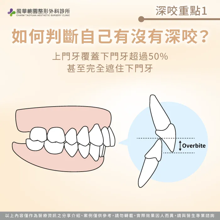 當上門牙覆蓋下門牙超過50%,甚至完全遮住下門牙,就可能是深咬 如何判斷自己有沒有深咬-深咬怎麼辦