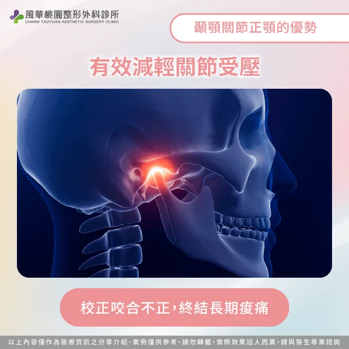 透過正顎手術校正咬合能顯著釋放顳顎關節受力負擔 校正咬合緩解關節壓力-顳顎關節改善