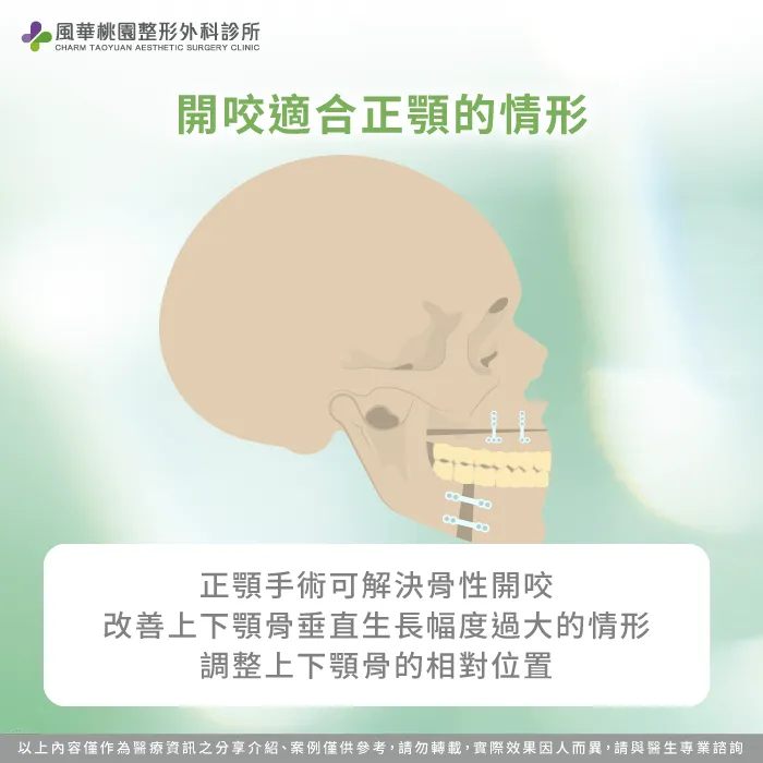 開咬適合正顎手術的情形-正顎手術開咬