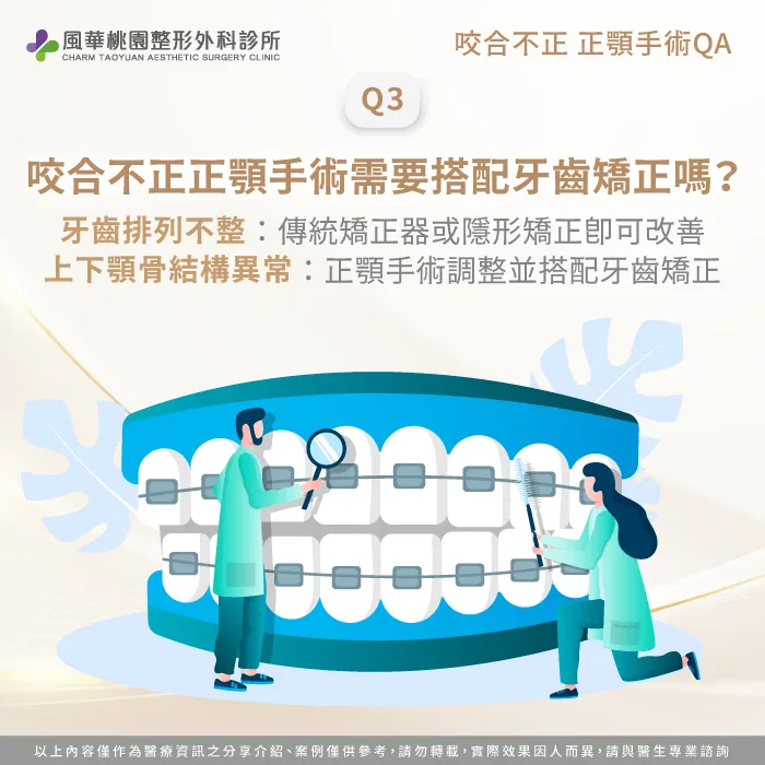 咬合不正正顎手術需要搭配牙齒矯正嗎-咬合不正正顎