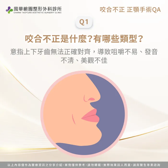 咬合不正是什麼-咬合不正正顎手術