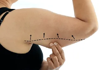 桃園手臂抽脂推薦-桃園手臂抽脂