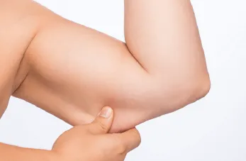 桃園手臂抽脂-桃園手臂抽脂手術