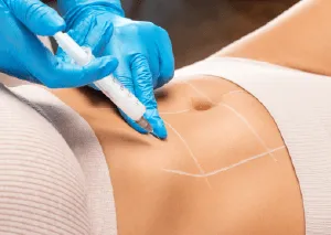 桃園自體脂肪豐臉-桃園自體脂肪豐臉推薦