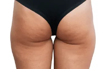 假胯寬抽脂-桃園大腿抽脂