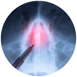 鼻中隔手術-桃園鼻頭整形手術