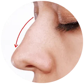 駝峰鼻手術-桃園鼻頭整形手術-