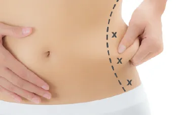 後腰抽脂-桃園腰腹抽脂